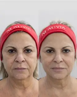 Tratamiento HIFU LIFT !N PLUS en el rostro