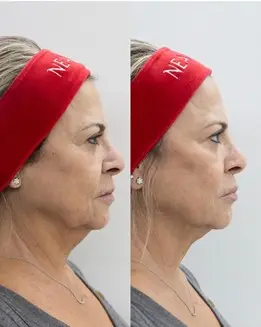 Rejuvenecimiento facial sin cirugía