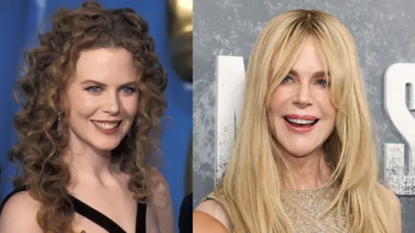 Nicole Kidman, antes y después de tratar su sonrisa gingival