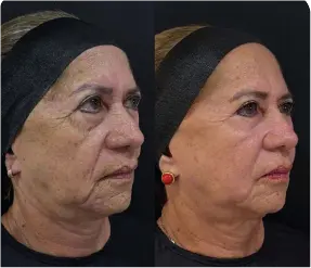 Tratamiento de manchas, textura y fotoenvejecimiento con ALMA HARMONY